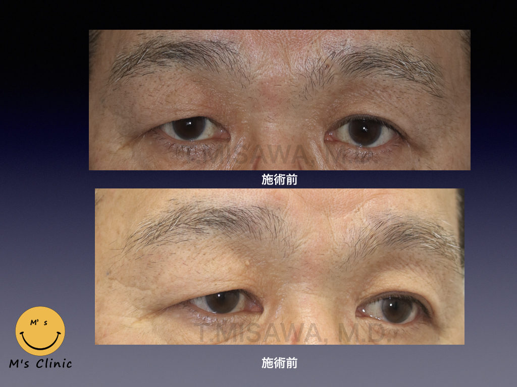 60代男性の右目一重の偽性眼瞼下垂　眉下皮膚切除による手術で改善
